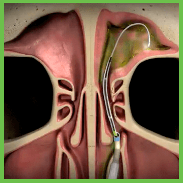 Is Balloon Sinuplasty a Good Option? - Houston Advanced Sinus