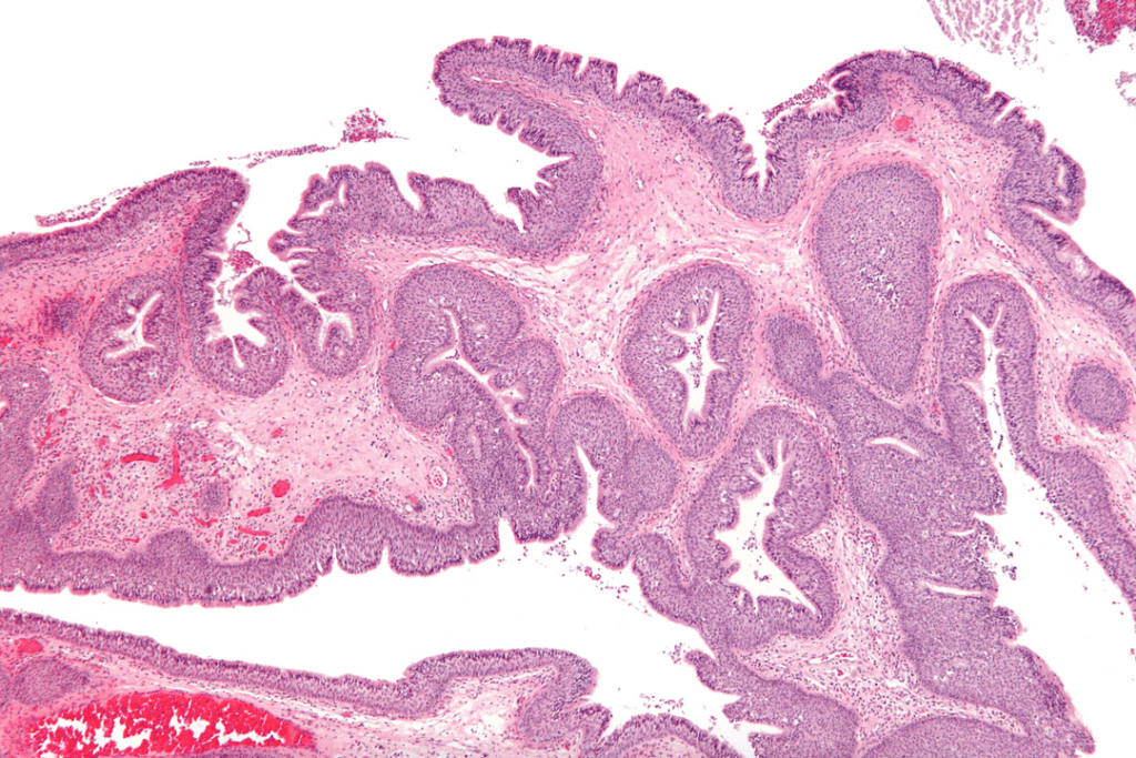 Managing Nasal Polyps All You Need To Know Houston Advanced Sinus