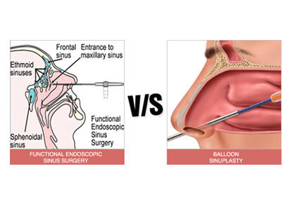 Nasal deals sinus surgery