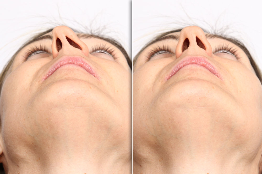 Deviated Septum Repair Houston TX Septoplasty Houston