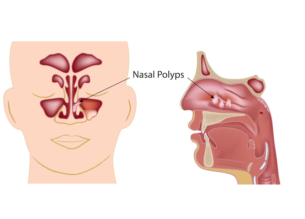 nasal-polyp-treatment-and-symptoms-houston-polyp-removal