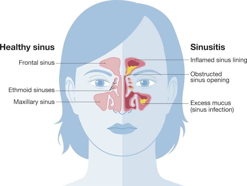 sinusitis graphic