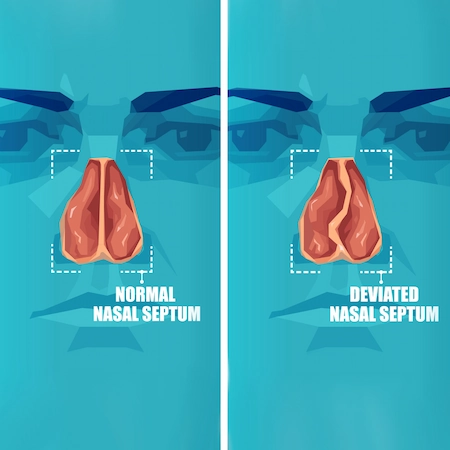 graphic depicting a deviated septum